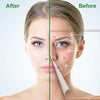 Glowy Skin | Acne Behandeling