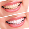 Teeth-Whitening | Tanden Bleek Set