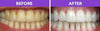 Teeth-Whitening | Tanden Bleek Set